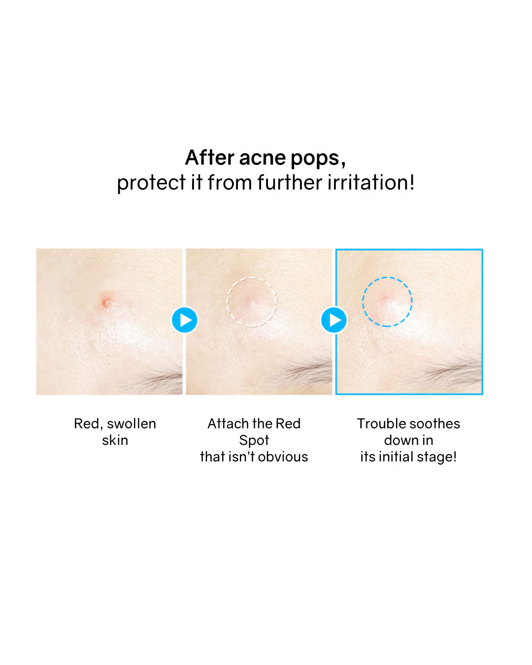 Hatherine Spot Care Patch Kit (76 patch)