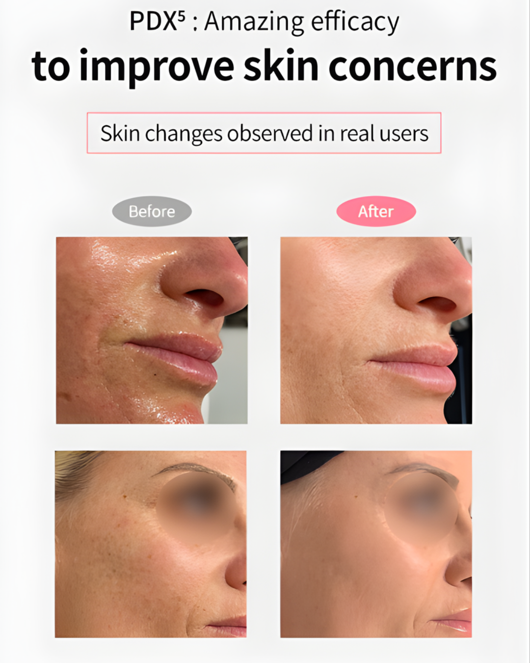 [PROMO] Dermaline PDX5 Skin Booster Total Solution & MTS Stamp